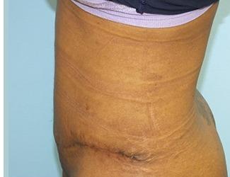 Tummy Tuck Before & After Patient #8195
