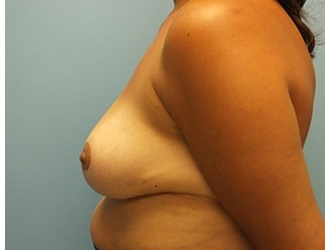 Breast Reduction Before & After Patient #8410