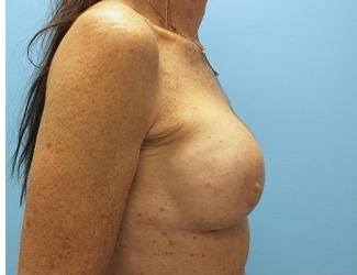 Breast Revision Before & After Patient #8240