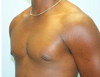 Gynecomastia Before & After Patient #8443