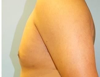 Gynecomastia Before & After Patient #8441