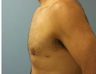 Gynecomastia Before & After Patient #8435