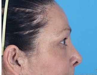 Browlift Before & After Patient #8461