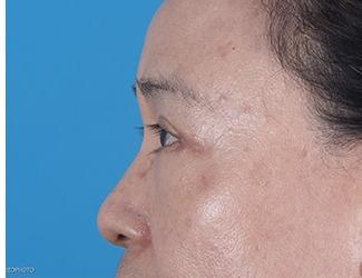 Browlift Before & After Patient #8460
