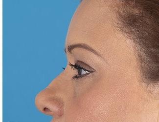 Browlift Before & After Patient #8458