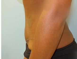 Tummy Tuck Before & After Patient #8192