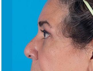 Browlift Before & After Patient #8459