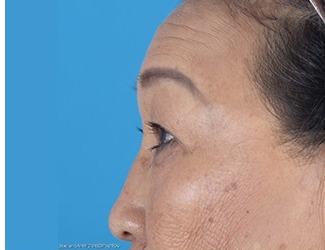 Browlift Before & After Patient #8457