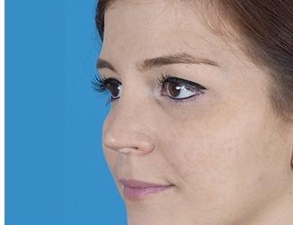 Rhinoplasty Before & After Patient #8809