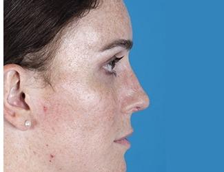 Rhinoplasty Before & After Patient #8808