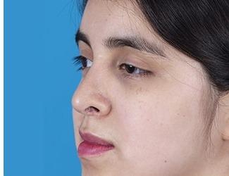 Rhinoplasty Before & After Patient #8807