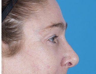 Blepharoplasty Before & After Patient #8533