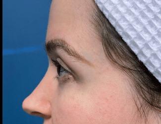 Blepharoplasty Before & After Patient #8485