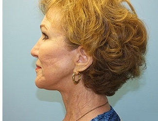 Facial Fat Grafting Before & After Patient #8745