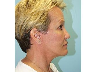 Facial Fat Grafting Before & After Patient #8741