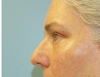 Facial Fat Grafting Before & After Patient #8744