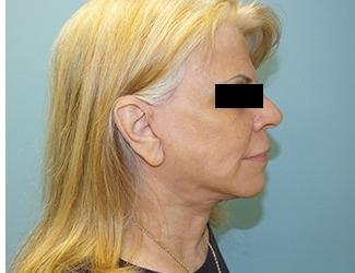 Facial Fat Grafting Before & After Patient #8740