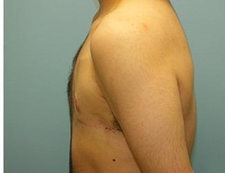 Female to Male Before & After Patient #8442