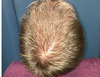 NeoGraft Before & After Patient #8827