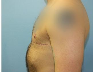 Female to Male Before & After Patient #8440