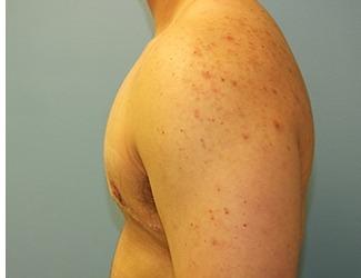 Female to Male Before & After Patient #8444