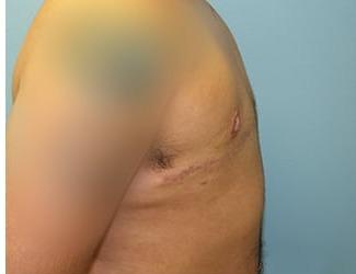 Female to Male Before & After Patient #8438
