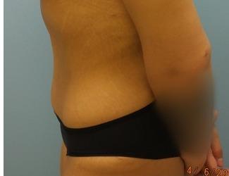 Tummy Tuck Before & After Patient #8197