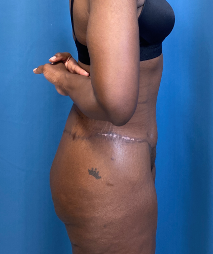 Tummy Tuck Before & After Patient #8204