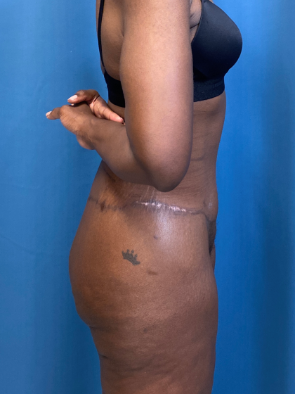 Lower Body Lift Before & After Patient #8029