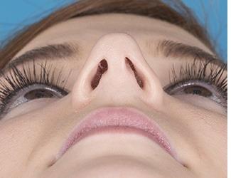 Rhinoplasty Before & After Patient #8809