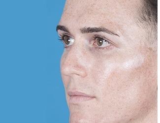 Rhinoplasty Before & After Patient #8808
