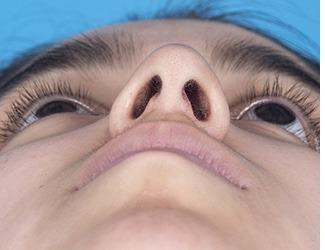 Rhinoplasty Before & After Patient #8807