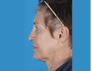Facial Fat Grafting Before & After Patient #8742