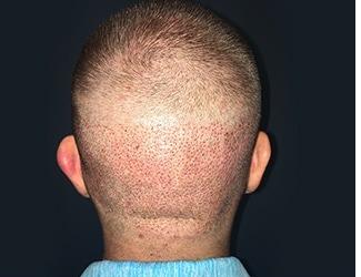 NeoGraft Before & After Patient #8827