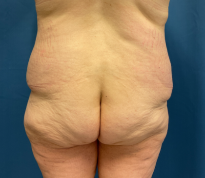 Lower Body Lift Before & After Patient #8028