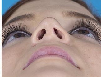Rhinoplasty Before & After Patient #8809