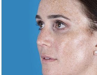 Rhinoplasty Before & After Patient #8808