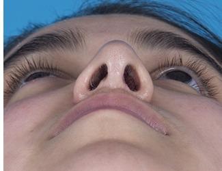 Rhinoplasty Before & After Patient #8807