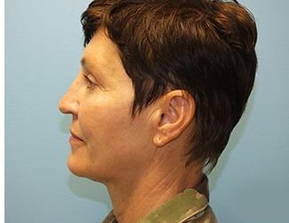 Facial Fat Grafting Before & After Patient #8742