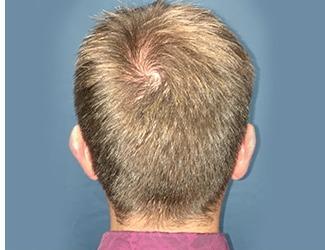 NeoGraft Before & After Patient #8827