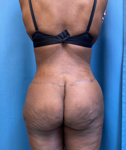 Tummy Tuck Before & After Patient #8204
