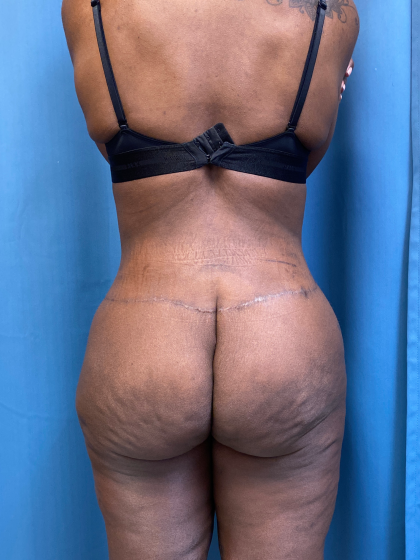 Lower Body Lift Before & After Patient #8029
