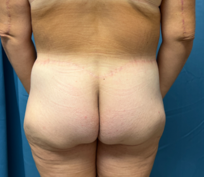 Lower Body Lift Before & After Patient #8028