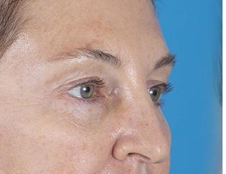Facial Fat Grafting Before & After Patient #8742