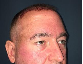 NeoGraft Before & After Patient #8827