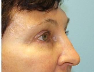 Blepharoplasty Before & After Patient #8480