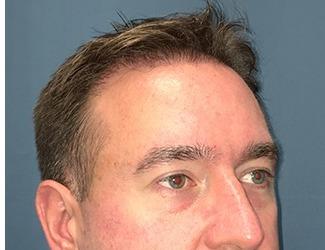 NeoGraft Before & After Patient #8827
