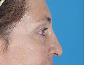 Facial Fat Grafting Before & After Patient #8742