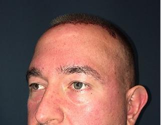 NeoGraft Before & After Patient #8827