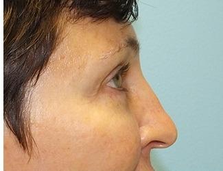 Facial Fat Grafting Before & After Patient #8742
